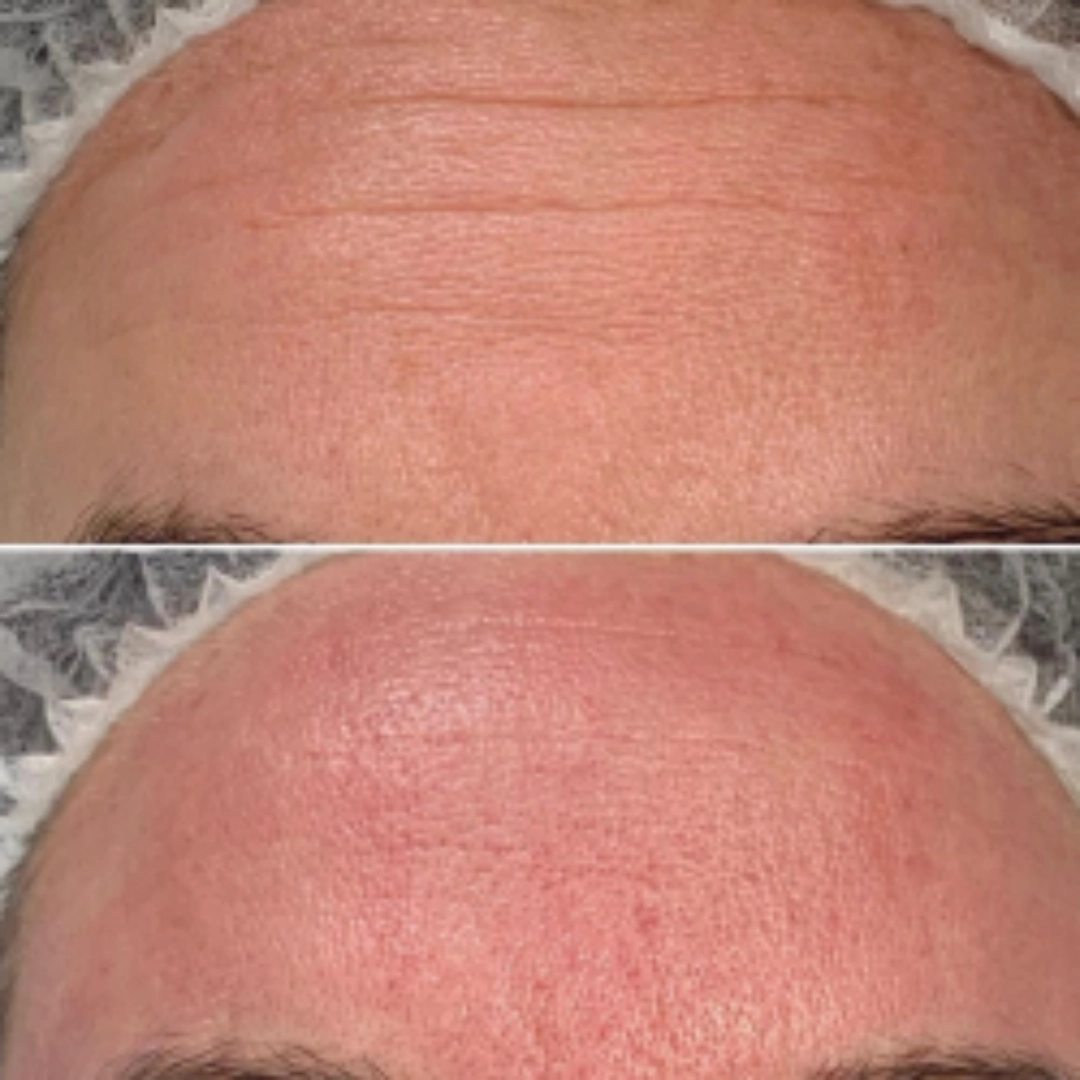 pure derma before after head